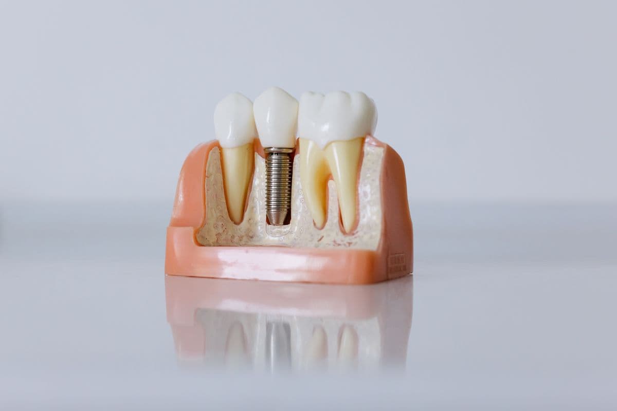 single tooth implant vs bridge Kharghar dental model showing implant between two teeth