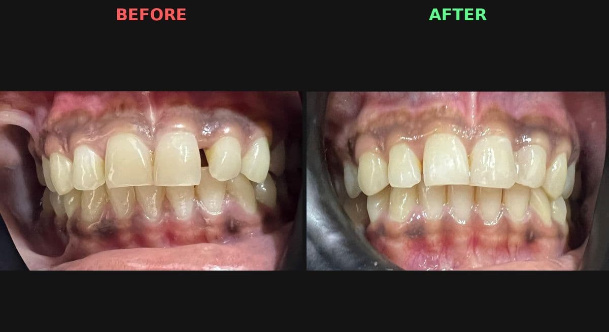 Before and after composite bonding to close a gap between the upper front teeth at Reform Dental Clinic, Kharghar