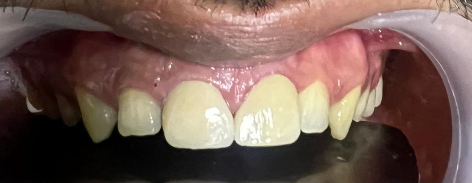 Upper front teeth after veneers closed the midline gap at Reform Dental Clinic Kharghar