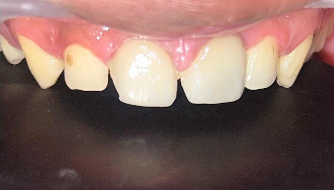 Midline diastema, a gap between the upper central incisors, before veneers at Reform Dental Clinic Kharghar