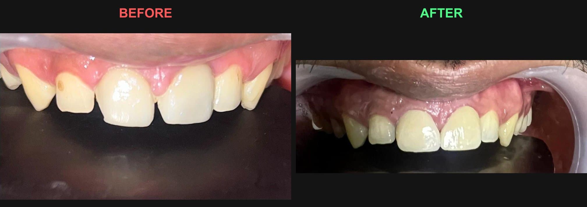 Before and after veneers closing a midline gap between the upper front teeth at Reform Dental Clinic, Kharghar