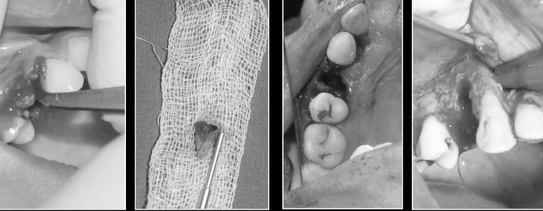 Removal of the retained root and the extraction site at Reform Dental Clinic Kharghar