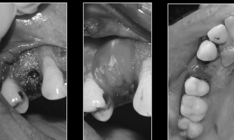 Bone graft and GBR membrane placement during dental implant surgery at Reform Dental Clinic Kharghar