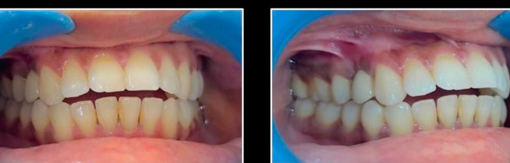 Before and after a dental implant case at Reform Dental Clinic, Kharghar
