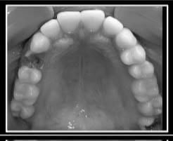 Upper arch at the first visit showing the fractured upper right premolar at Reform Dental Clinic Kharghar