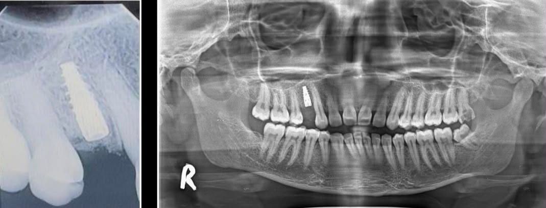 Post-operative X-ray showing the dental implant in position at Reform Dental Clinic Kharghar