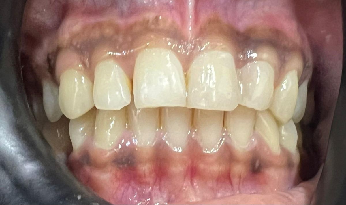 Gap between the upper left central and lateral incisor closed after composite bonding at Reform Dental Clinic Kharghar