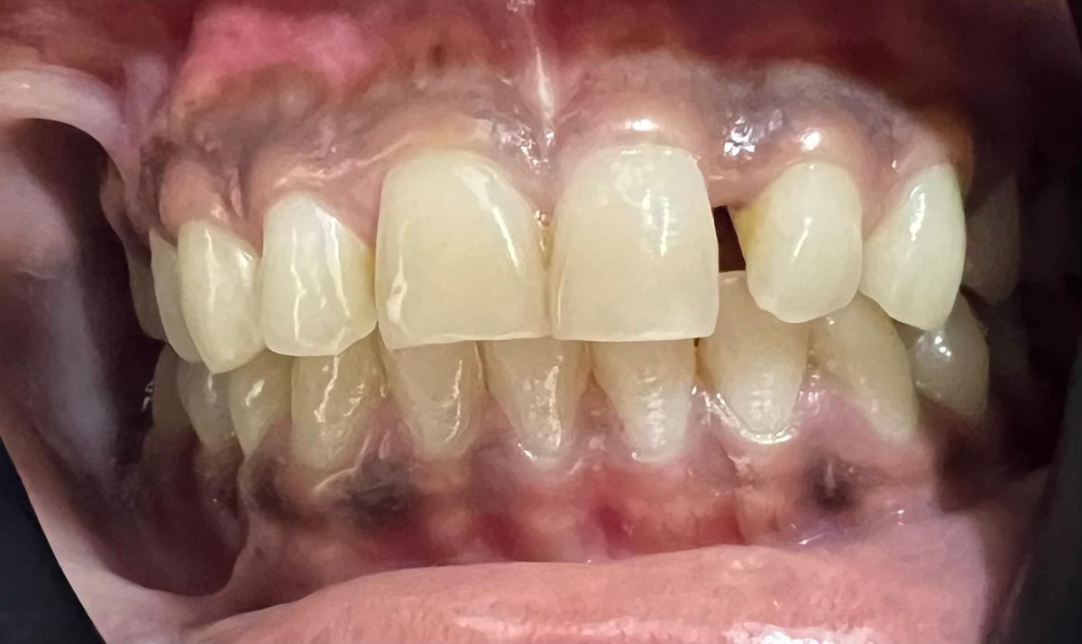 Gap between the upper left central and lateral incisor before composite bonding at Reform Dental Clinic Kharghar
