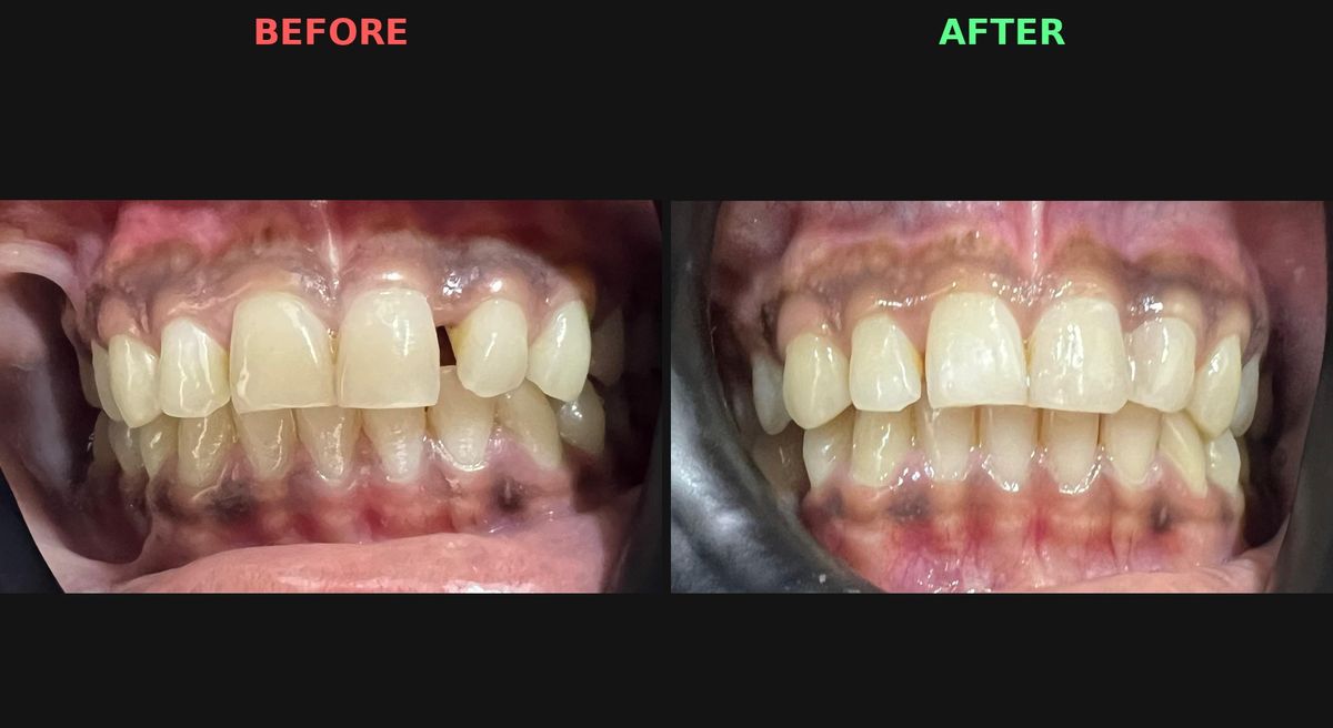 Before and after composite bonding to close a gap between the upper front teeth at Reform Dental Clinic, Kharghar
