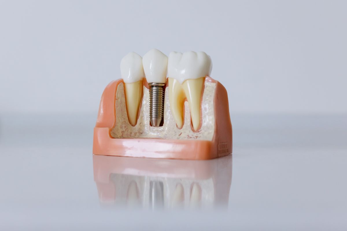 single tooth implant vs bridge Kharghar dental model showing implant between two teeth